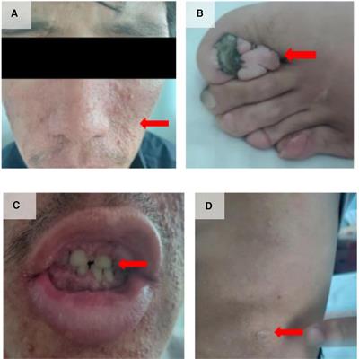 Case Report: Patent ductus arteriosus with tuberous sclerosis complex